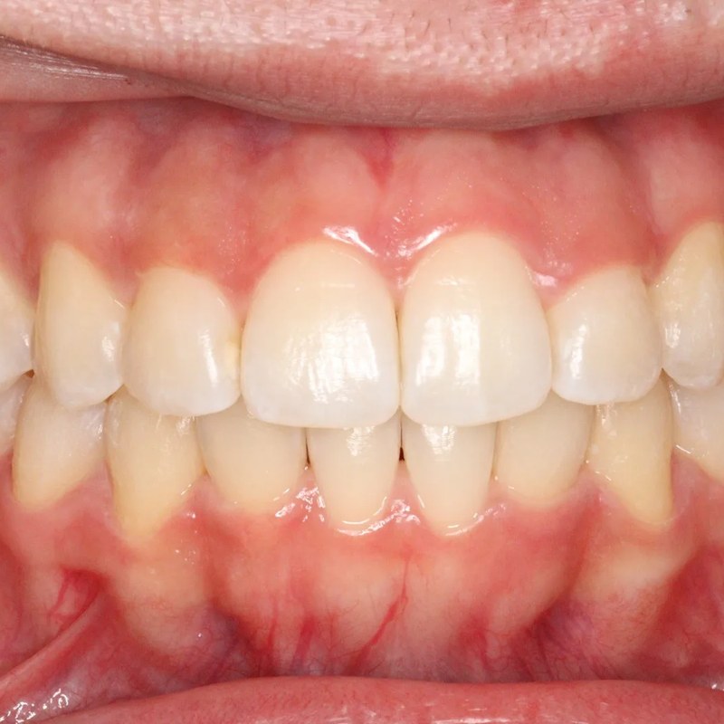 After Invisalign