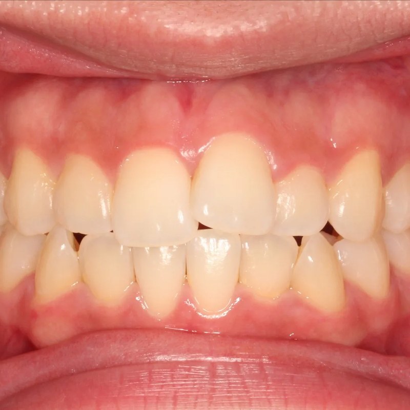 Before Invisalign