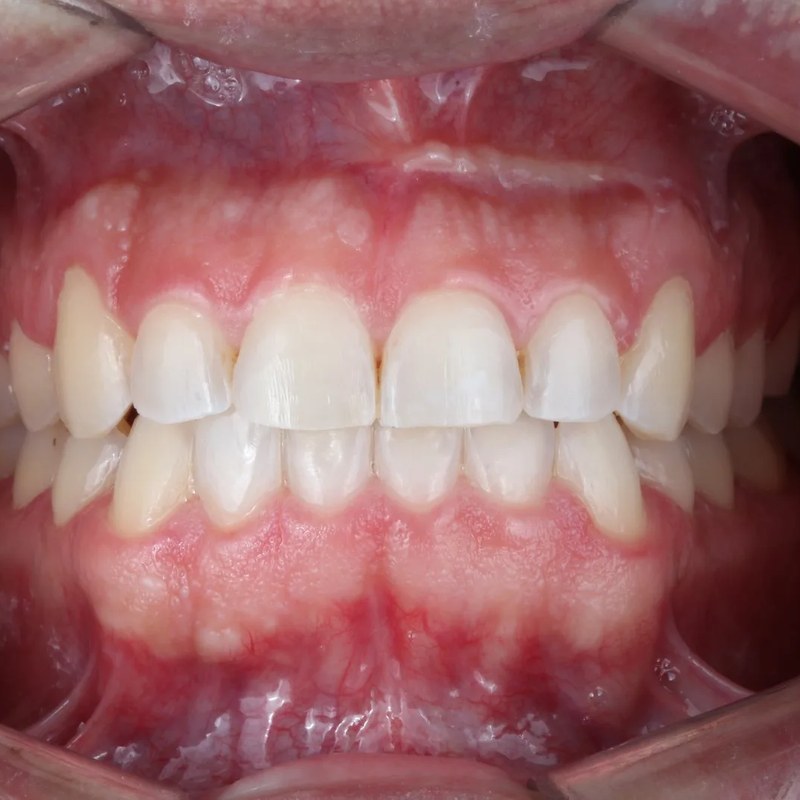 After Invisalign - Upper & lower arch alignment