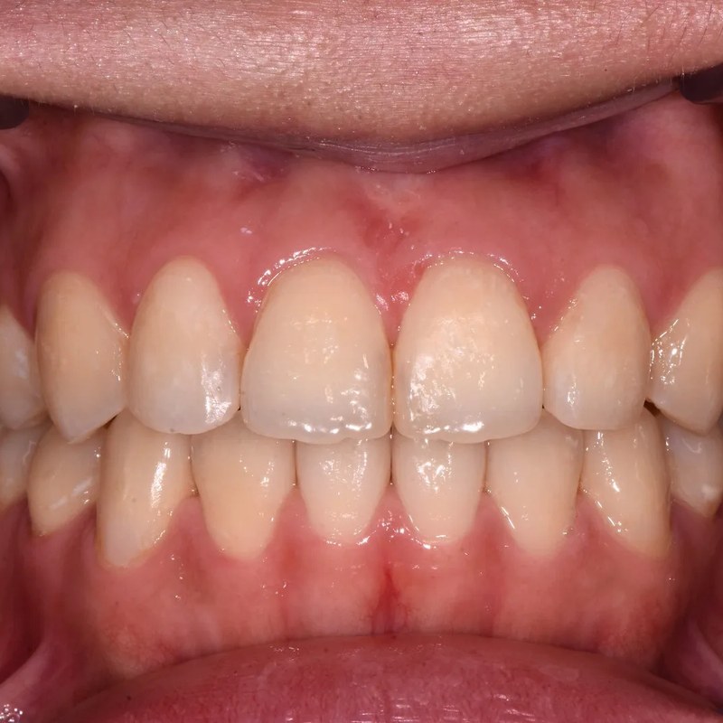 After Invisalign - Crowding resolution