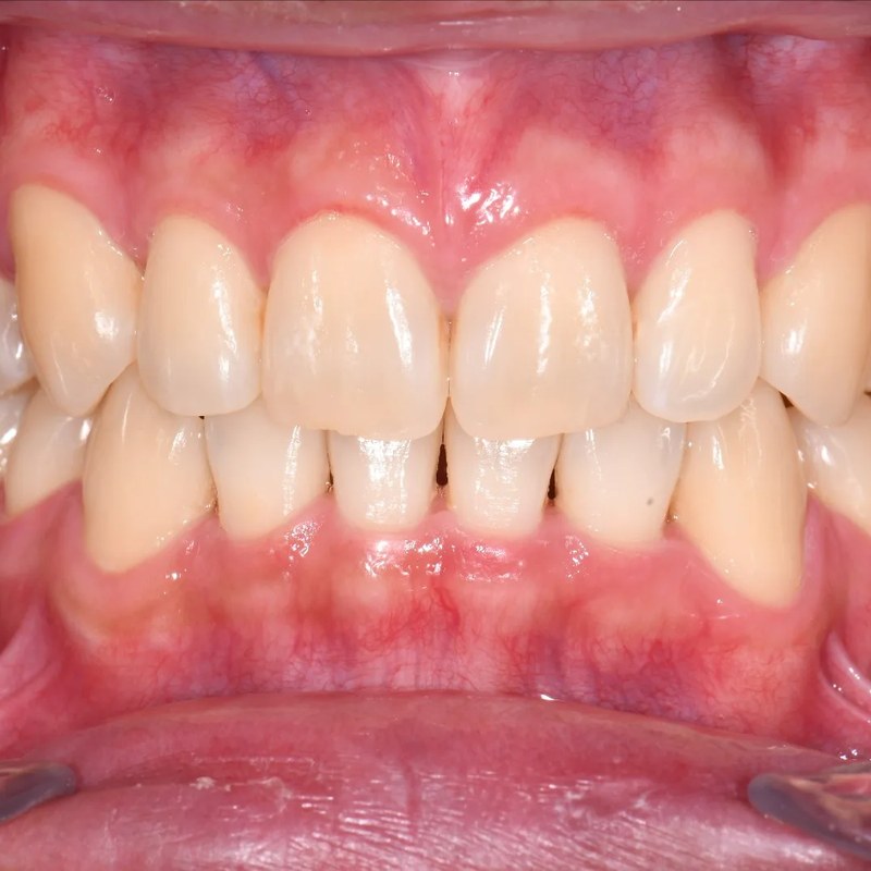 After Invisalign - Bite correction