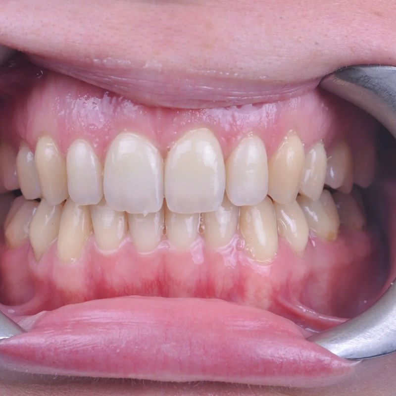 After Invisalign - Full arch straightening