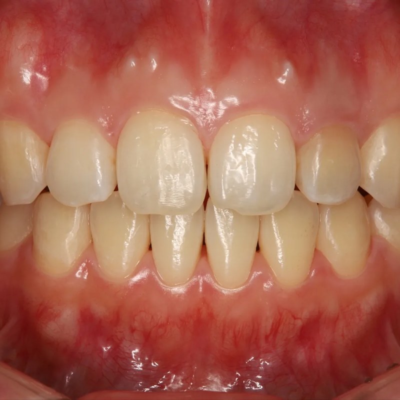 After Invisalign - Spacing & rotation