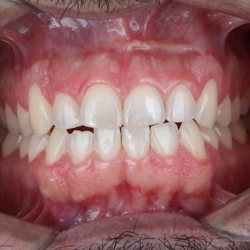 Before Invisalign - Upper & lower arch alignment