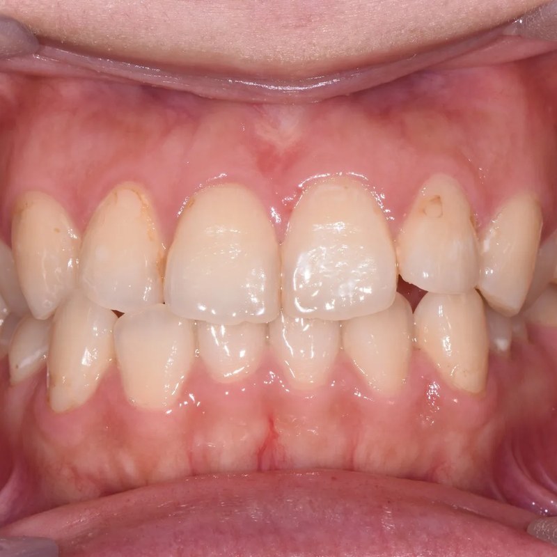 Before Invisalign - Crowding resolution