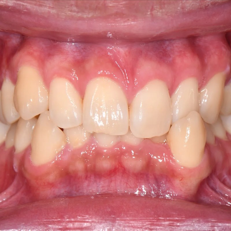 Before Invisalign - Bite correction