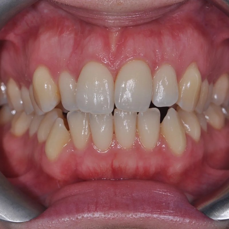 Before Invisalign - Full arch straightening