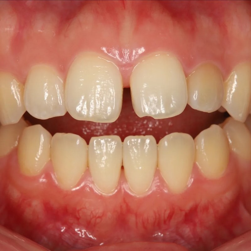 Before Invisalign - Spacing & rotation